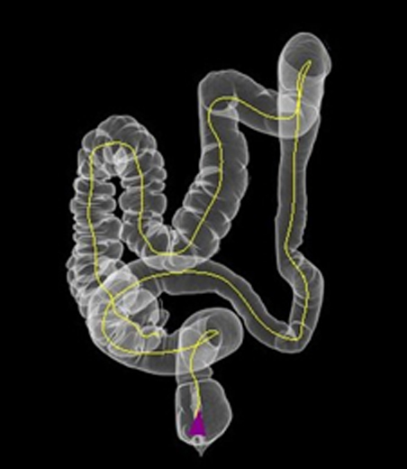 大腸CT イメージ