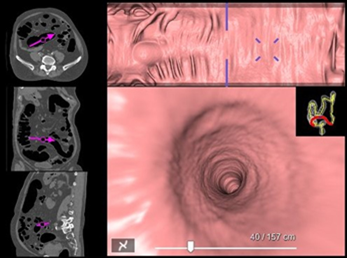 大腸CT 検査画像イメージ