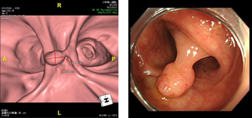 大腸CT 有茎性ポリープ